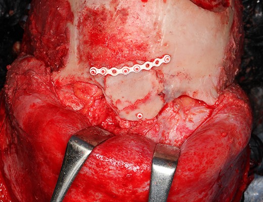 After reduction of the protrusions, anterior wall of frontal sinus was scraped leaving mucosa intact. Outer table of parietal bone was transplanted and fixed with an absorbable plate and screws.