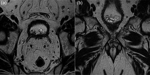 MRI multiparametric axial (a) and coronal (b) images of an irregularity at the base of the bladder neck.