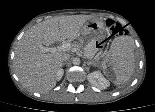 CT abdomen image shows flow in pseudoaneurysm (arrow) posterior to the stomach and the subcapsular splenic haematoma.