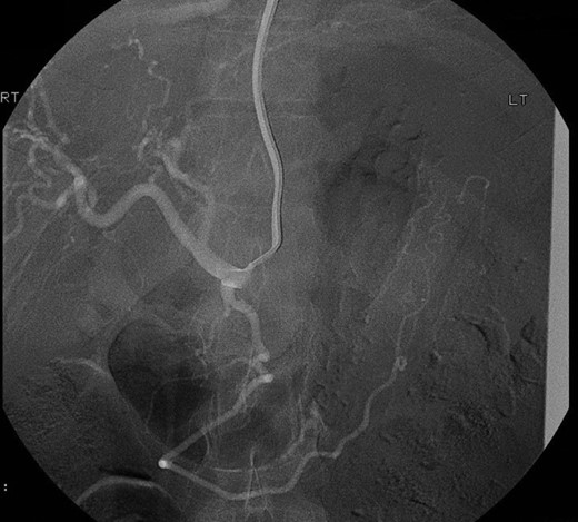 Selective angiogram of the celiac trunk failing to demonstrate the pseudoaneurysm.