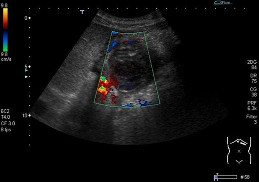 Ultrasound image demonstrates the thrombosed pseudoaneurysm 24 h post thrombin injection.