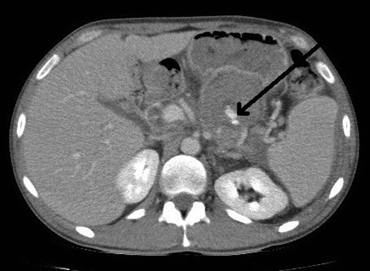 CT abdomen image post thrombin injection shows flow in the pseudoaneurysm (arrow).