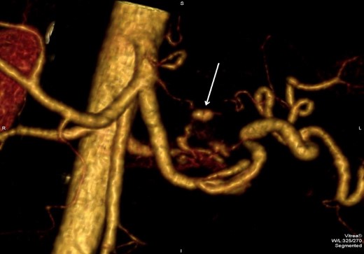 3D CTA reconstruction demonstrates the pseudoaneurysm (arrow) originating from the unnamed vessel.