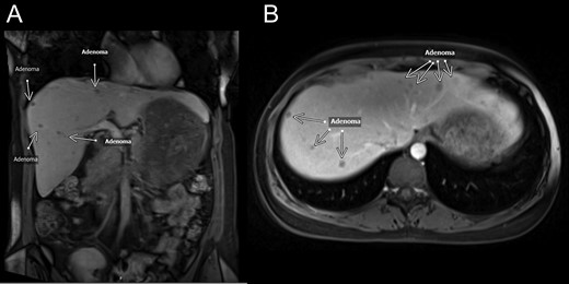 MRI—coronal (A) and transverse (B) MRI sections showing multiple lesions within both lobes of the liver. White arrows mark lesion locations. Per radiology notes, each lesion measured from 0.5 to 1.5 cm in diameter. There were at least 50 lesions in total.