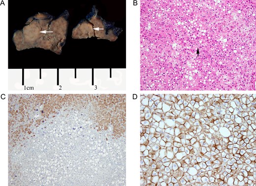 (A) Gross section of left lateral segment showing hepatic adenoma. White arrows indicate adenoma location. (B) H&E stain of hepatic adenoma section. Note diffuse lipid deposition within the adenoma itself and an unpaired artery without other portal structures. Magnification at ×20. (C) LFABP stain. Diffuse LFABP staining was noted within the surrounding liver parenchyma. No staining was seen within the adenoma itself. Magnification at ×10. (D) Beta-catenin staining. Immunochemical stain for beta-catenin showed no nuclear localization. Magnification at ×40.