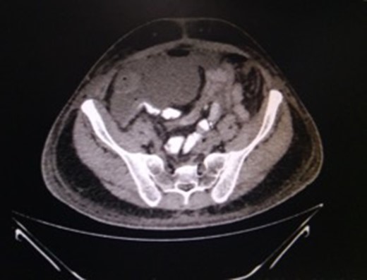 CT-abdomen showing pelvic collection. Source: Department of Radiology, Sir Ganga Ram Hospital, New Delhi.