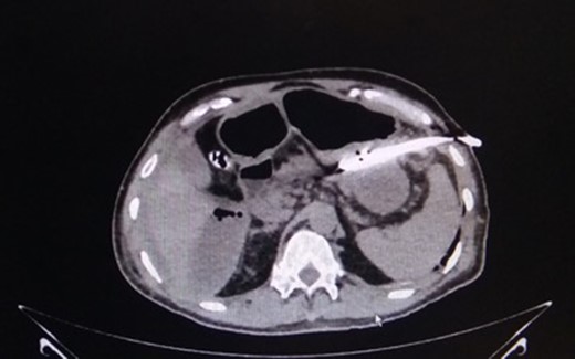 CT-image of drain in situ draining intra-peritoneal leak contents. Source: Department of Radiology, Sir Ganga Ram Hospital, New Delhi.