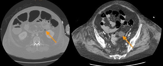 CT-scan revealed free gas and fluid in the retroperitoneum as a sign of a covered perforation of colonic diverticula.