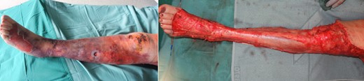 Preoperative status of the left leg; right: picture shows the left leg immediately after radical debridement.