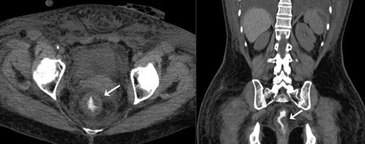 Thickening of the rectal wall.