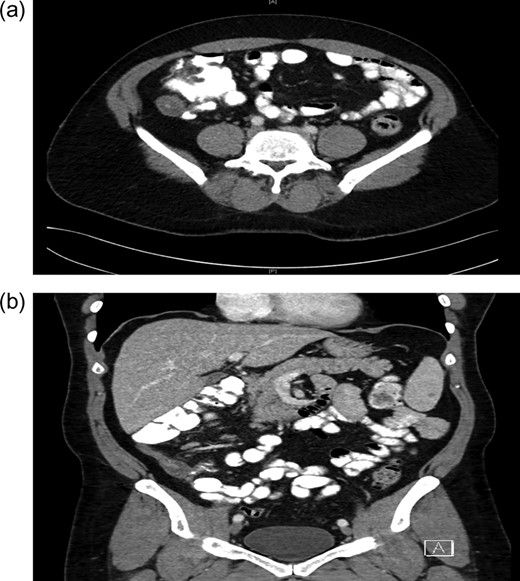 (a) Computed tomography of the axial view of abdomen showing mass in base of appendix. (b) Computed tomography of the coronal view of abdomen showing mass in base of appendix.