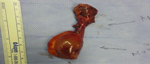 Specimen with mass at the base of the appendix (arrow).