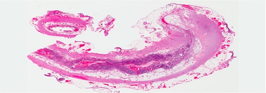 The tip and the middle part of the appendix with no specific pathology (H&E stain, low power).