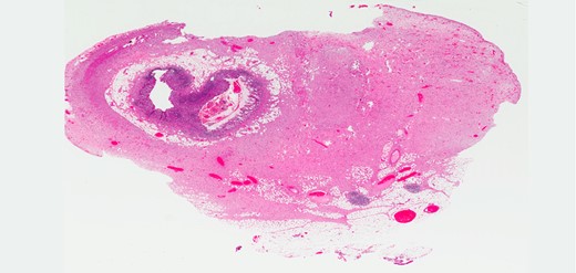 The base of the appendix with the mass (H&E stain, low power).
