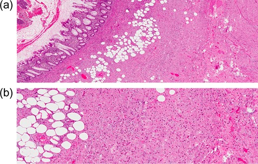 (a) H&E stain of a lesion in the appendiceal wall with infiltrative nature (intermediate power). (b) H&E stain of abundant spindle cell, dispersed in loss fibromyxoid stroma, infiltrating the fat (high power).