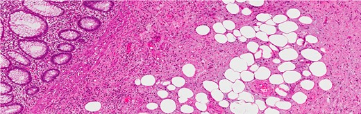 Infiltration into the sub-mucosa of the appendix (H&E stain, high power).