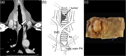 Chest computed tomography revealed a mass (arrow), measuring 4.5 cm along the longitudinal axis of the trachea, involving the right wall of the junction of the cervical and mediastinal tracheae (a). Cervical collar incision with median sternotomy provided sufficient mobilization of the entire trachea; from the cervical level to the left and right main bronchi origins (b). The resected specimen measured 5.0 cm (eight tracheal cartilage rings) longitudinally (c).