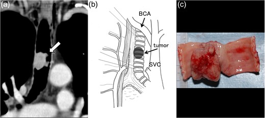 Computed tomography revealed a mass (arrow), measuring 1.8 cm longitudinally, involving the right wall of the lower trachea (a). Right posterolateral incision provided sufficient exposure of the lower trachea (b). The resected specimen measured 3.0 cm (six tracheal cartilage rings) longitudinally (c). Ao, Aorta; SVC, superior vena cava; PA, pulmonary artery; BCA, brachiocephalic artery.