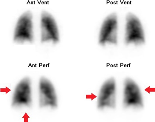 VQ scan showing bilateral ventilation perfusion mismatches, indicative of multiple pulmonary emboli. Ant = anterior; post = posterior; vent = ventilation; perf = perfusion.