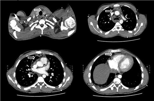 CT scan of neck and thorax showing mediastinal/cervical emphysema (hollow white arrows) and right empyema (solid white arrow).