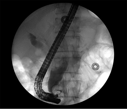 ERCP showed severely dilated CBD.