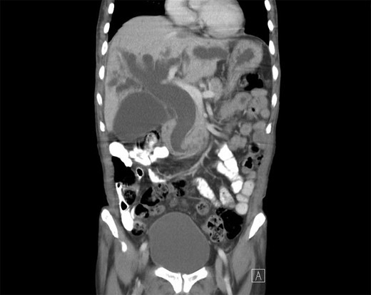 CT of the abdomen and pelvis showing severely dilated intra and extrahepatic bile ducts.