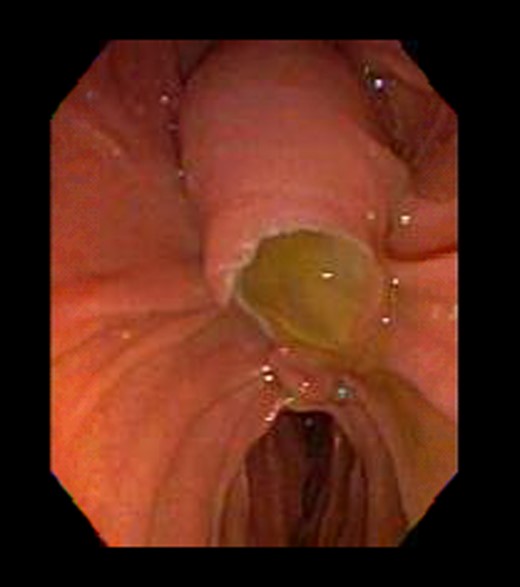 Repeat endoscopy 1 week after ERCP with sphincterotomy and stent placement shows thick mucus obstructing CBD.