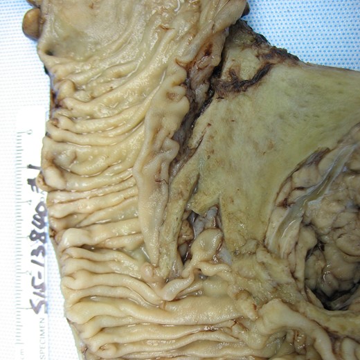 Gross pathology showing granular lesion of distal CBD, normal pancreatic duct, no mass in pancreas or papilla of Vater.