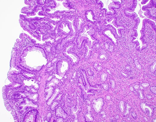 Microscopic appearance (H&E, ×20). Hyperplastic surface epithelium with myofibroblastic stromal proliferation.