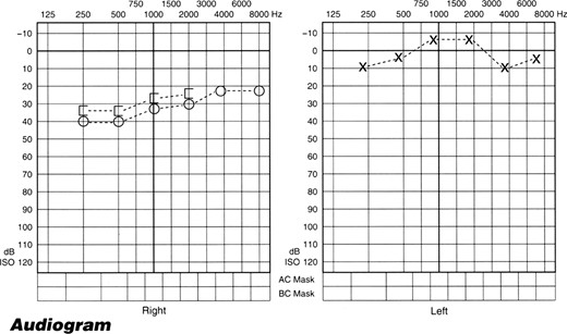 Pure tone audiogram showing 30–40 dB sensorineural hearing loss in the right ear mainly affecting the low frequencies.
