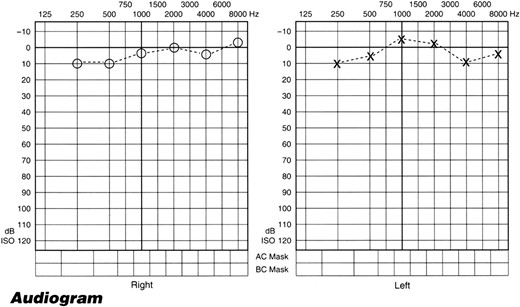 Pure tone audiogram showing hearing levels return to normal in the right side.