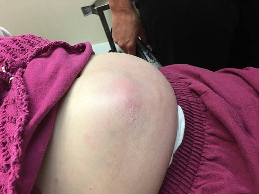 Initial physical exam of the patient revealed a palpable mass in the abdomen along with obvious skin erythema and irritation most likely secondary to the mass located just below the skin.