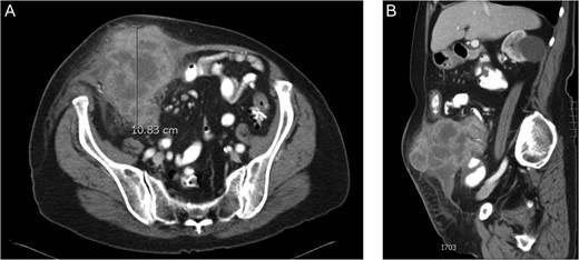 (A) CT scan of the abdomen in cross section revealing a large right sided colon cancer eroding through the rectus sheath almost to the level of the skin. As seen in the image, the patient was not obstructed at the time of presentation. (B) CT scan showing the mass from a sagittal perspective. The liver had no evidence of metastasis.