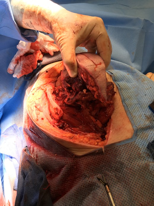 An initial elliptical incision was made measuring ~15 cm in length. The incised abdominal wall was then mobilized to provide exposure of intra-abdominal structures attached to the mass. All attached structures were removed en bloc with the abdominal wall mass.