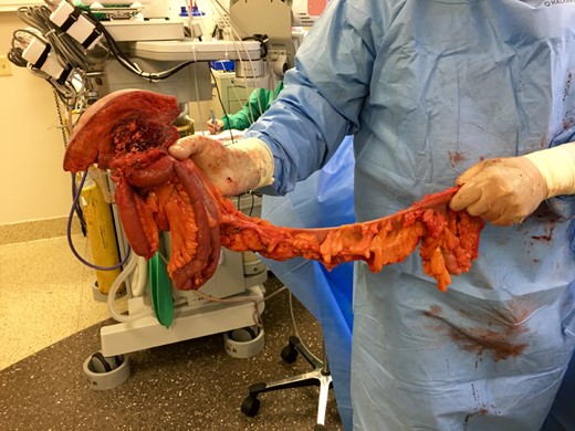 En bloc specimen of the abdominal wall mass, three feet of ileum, and right hemicolectomy (right ovary not shown).
