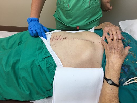 Abdomen on 6-week post-op follow up showed no evidence of hernia and had an appropriate healing midline incision.