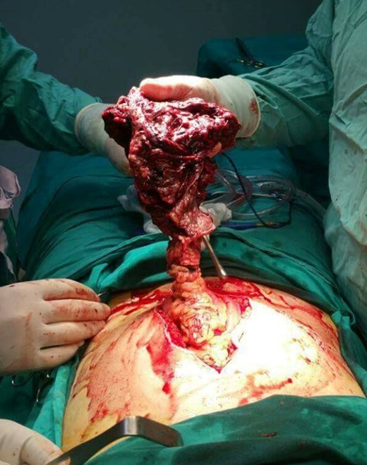 Torsion of the greater omentum. Intra-operative finding through exploratory laparotomy.