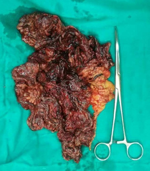 Dissection of the twisted omentum. Post-operative specimen.