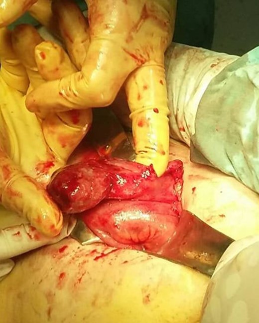 Intraoperative finding of gangrenous appendicitis.