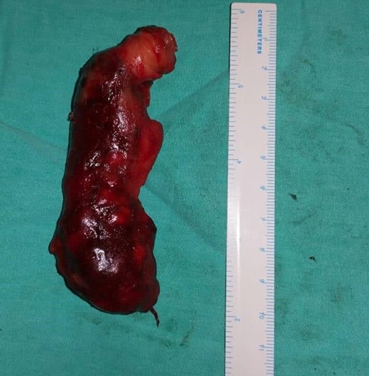 Gangrenous appendix. Excised specimen.