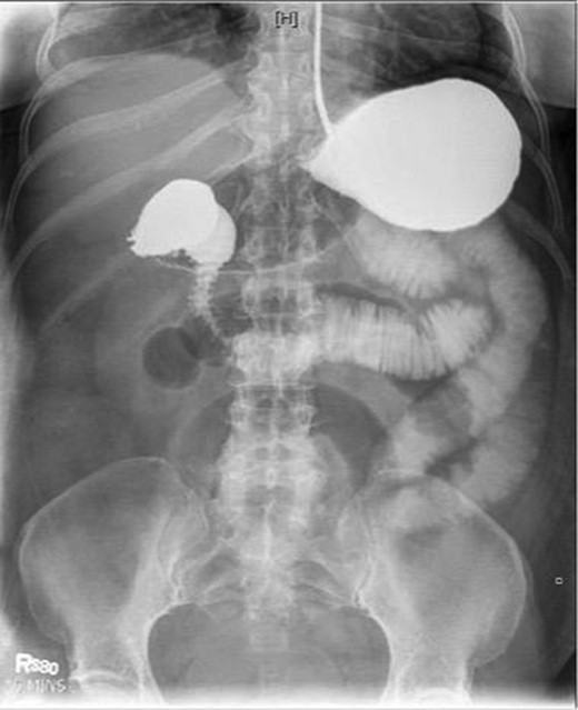 Fluoroscopic barium study demonstrating oral contrast agent progression through the small bowel at 5 min after ingestion.