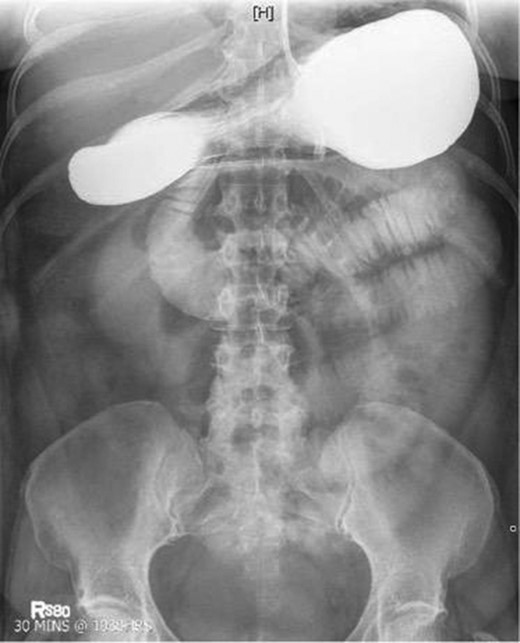 Fluoroscopic barium study demonstrating oral contrast agent progression through the small bowel at 30 min after ingestion.