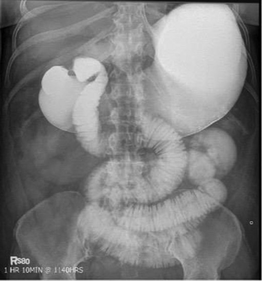 Fluoroscopic barium study demonstrating oral contrast agent progression through the small bowel at 1 h after ingestion. The stomach is distended, with dilated bowel loops throughout the abdomen.