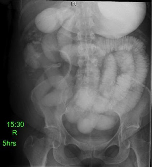 Fluoroscopic barium study demonstrating oral contrast agent progression through the small bowel at 5 h after ingestion. Dilated bowel loops can be visualized throughout the abdomen, and transit time is delayed. Impression—high-grade distal small bowel obstruction.