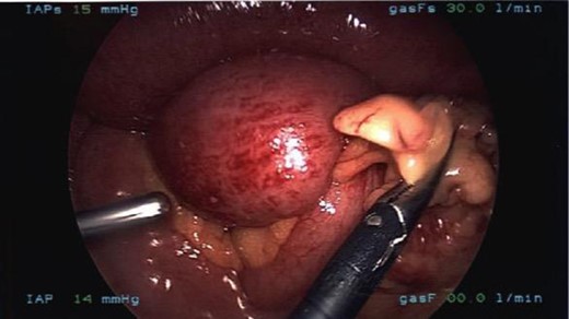 Laparoscopic visualization of the transition point of the obstruction in the distal jejunum caused by a band of omentum.