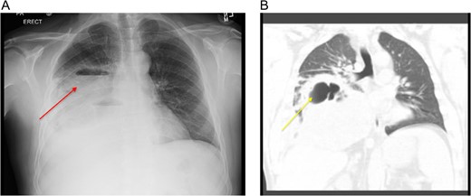 (A) CXR showing a large loculated right hydropneumothorax of the right lower lung lobe. (B) Computed tomography scan showing a large loculated right hydropneumothorax of the right lower lung lobe.