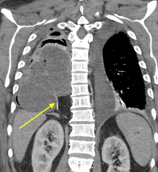Coronal view showing persistent empyema and anomalous arterial supply into sequestration.