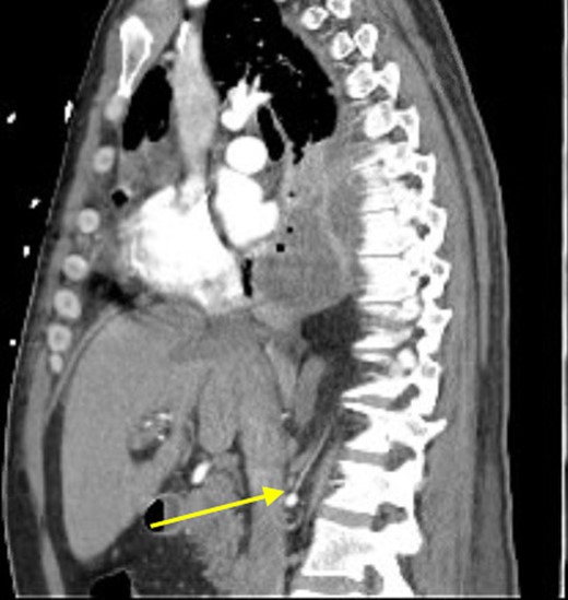 Sagittal view showing anomalous bloody supply originating from proximal right renal artery.