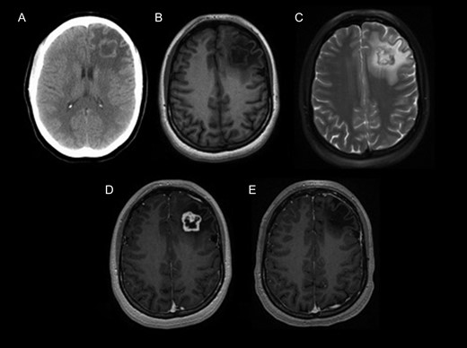 MRI tomography. (A) Non-contrast computed tomography shows heterogeneous left frontal lobe mass with a hyperdense peripheral rim and surrounding vasogenic edema without calcification. Pre-contrast (B) and post-contrast (C) T1-weighted MRI images, and T2-weighted MRI (D), show an intra-axial heterogeneously enhancing left frontal lobe mass with surrounding vasogenic edema. (E) 5-Year postoperative T1-weighted post-contrast MRI shows gross total resection of the tumor without recurrence.