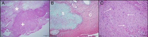 Tumor pathology (formalin fixed paraffin embedded). (A) Tumor at low magnification reveals a biphasic pattern of a loose collagenous central zone (*) and a compact peripheral zone (+), H&E stained, original magnification ×2. (B) Trichrome stain reveals a well-circumscribed collagen-rich schwannoma (S, green color) separated from the adjacent gliotic cerebral parenchyma (C), original magnification ×10. (C) At higher magnification, this H&E stained section reveals a palisaded pattern of neoplastic spindle cell nuclei (arrows), original magnification ×20.